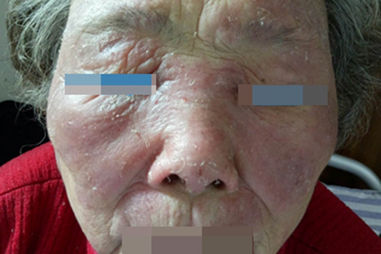 季节性接触性皮炎面部症状图