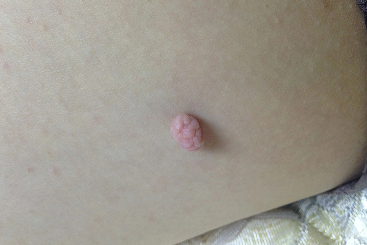 胯下尖锐湿疣图 胯下尖锐湿疣图