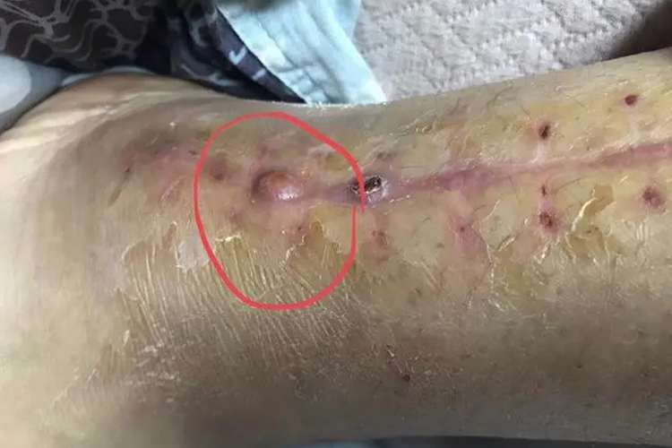 伤口结痂里面化脓图