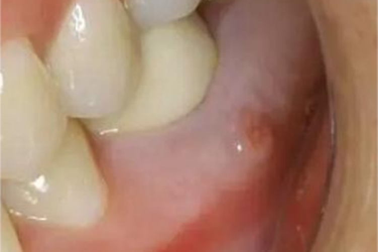 慢性根尖周炎症状图