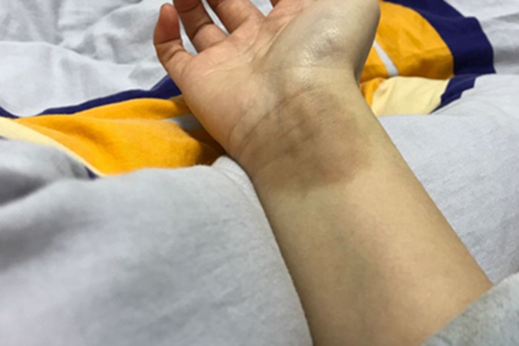 一度烫伤手腕皮肤发黑图 一度烫伤手腕皮肤发黑图
