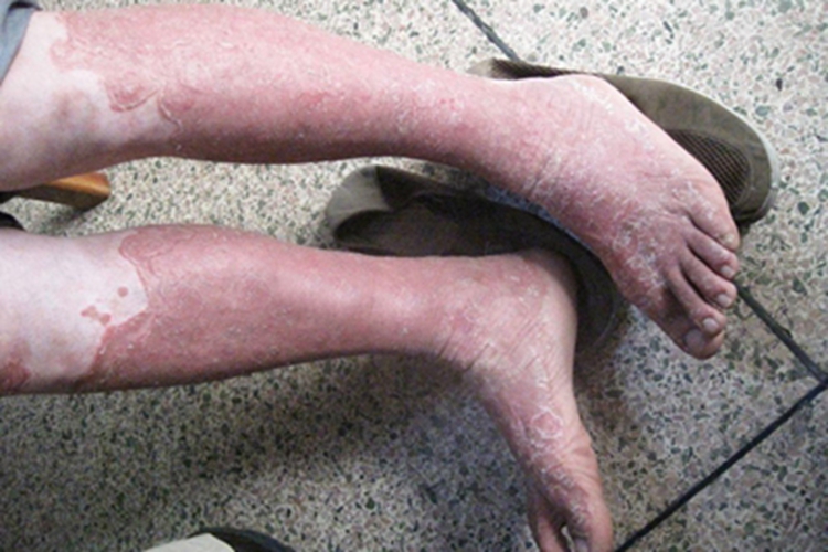 毛发红糠疹小腿脱屑图 毛发红糠疹小腿脱屑图