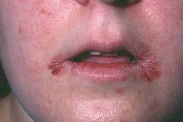 接触性口角炎裂口图 接触性口角炎裂口图