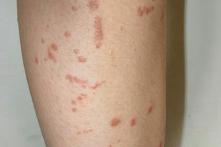 疣状肢端角化病大腿症状图