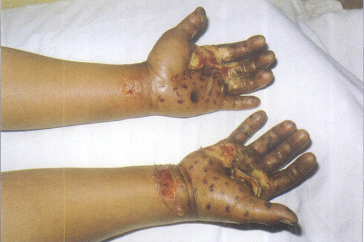 电弧烧伤手掌症状图 电弧烧伤手掌症状图