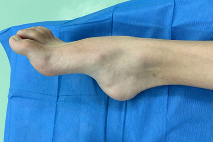 先天性高弓足脚背畸形图