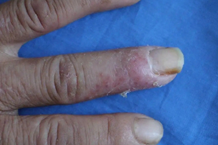 连续性肢端皮炎手指脓疱图