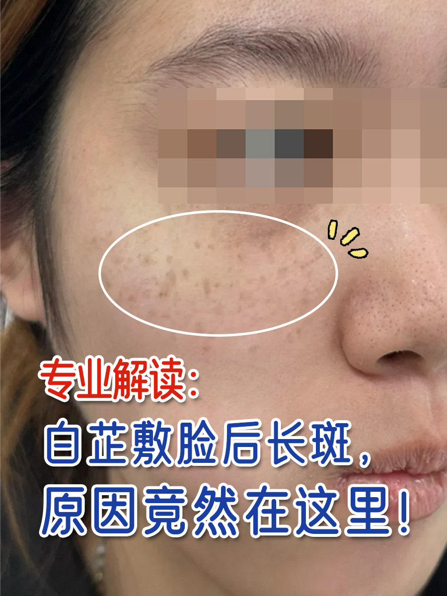 专业解读：白芷敷脸后长斑，原因竟然在这里！