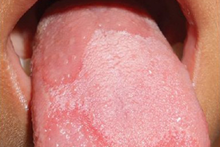 地图舌舌苔剥脱形成红斑图