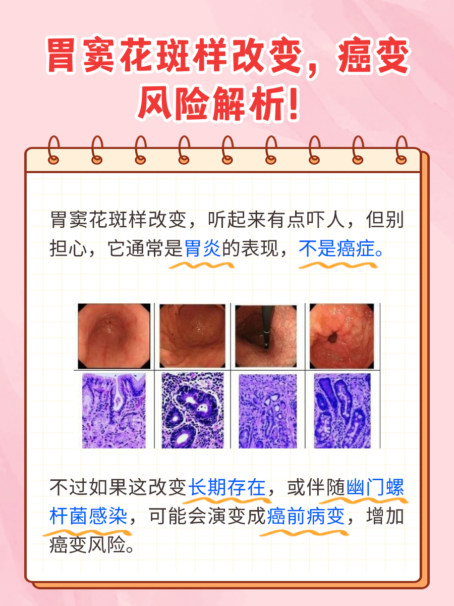 胃窦花斑样改变，究竟会不会癌变？