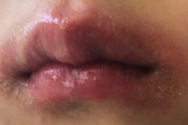 急性光化性唇炎脱屑图