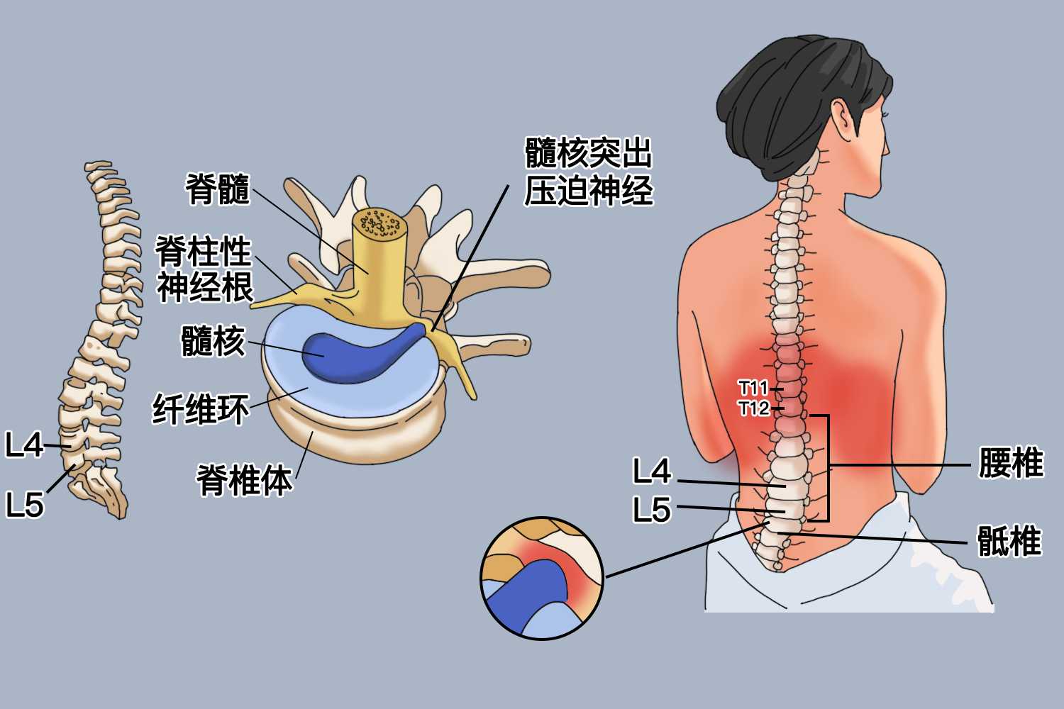 L4-5椎间盘突出位置图