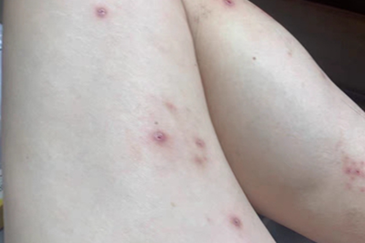 成人痒疹大腿结痂图
