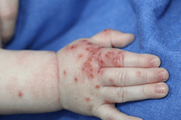 特应性皮炎手部症状图