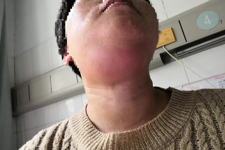 女性右侧颌下腺肿瘤图