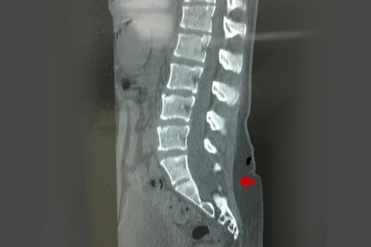 先天性隐性脊柱裂影像图