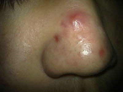 鼻疖的症状和图片