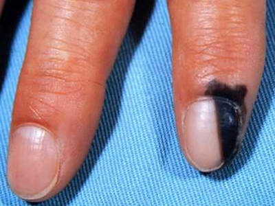 浅表播散型黑色素瘤可以出现在手指甲处,表现为指甲及周围的皮肤呈