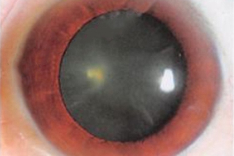 皮质性白内障白斑图