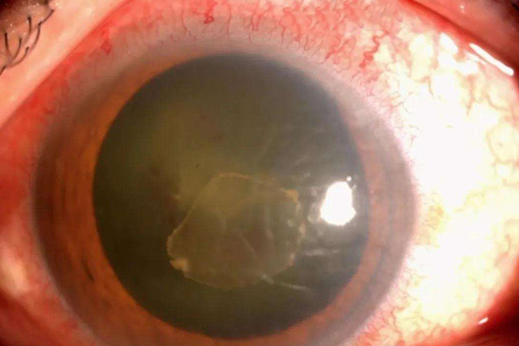 前葡萄膜炎初期图