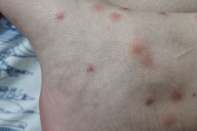 跳蚤叮咬脚踝小红疙瘩图