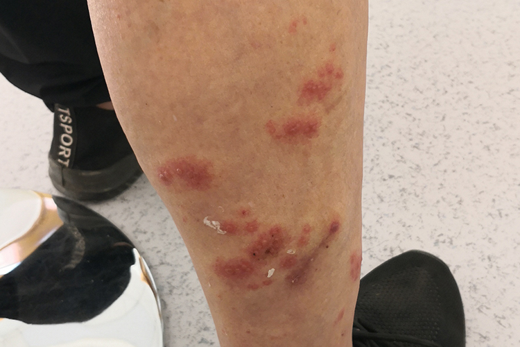 带状疱疹腿部红斑丘疹图 带状疱疹腿部红斑丘疹图