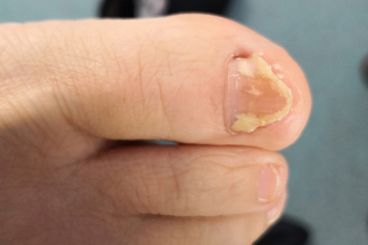 脚趾远端侧位甲下型甲癣图