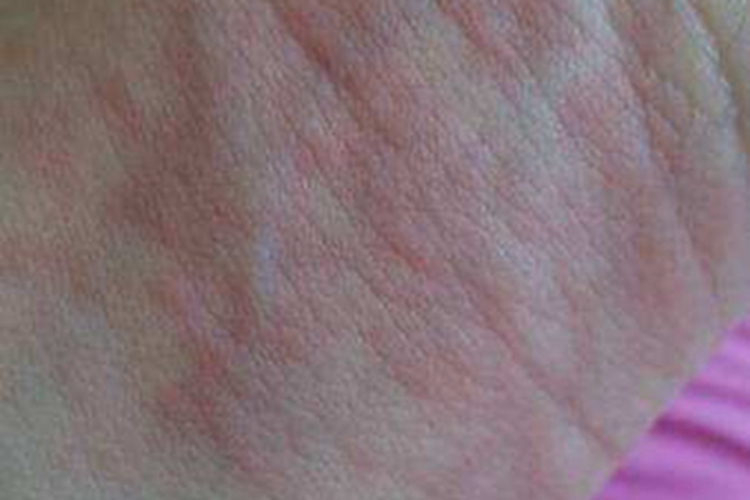 革螨皮炎手腕红色风团图