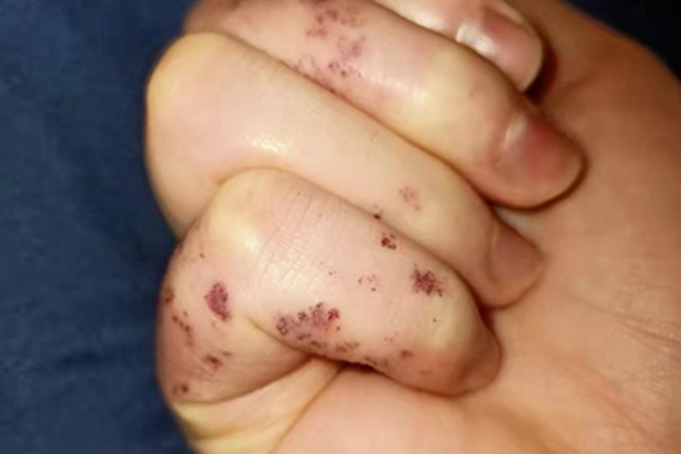 血管角化瘤手指红点图