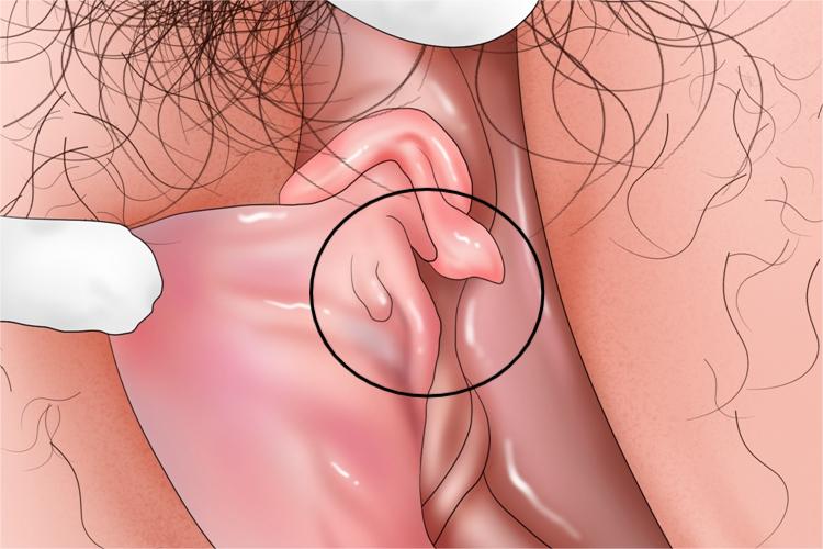 女性尖锐湿疣早期图