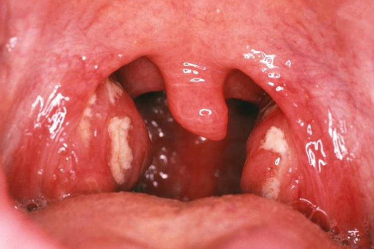 大人得白喉病图 大人得白喉病图