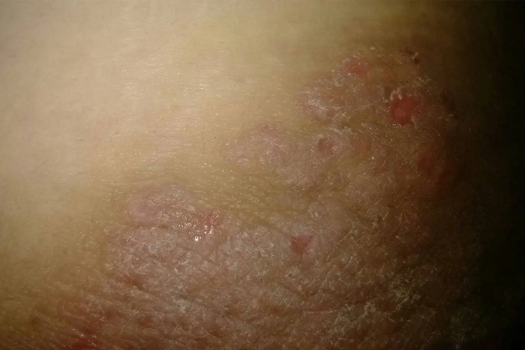 大腿根部内侧湿疹图