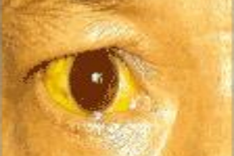 胆汁淤积性黄疸眼球发黄图 胆汁淤积性黄疸眼球发黄图