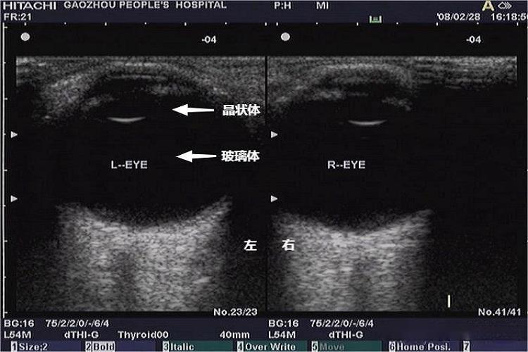 正常眼部超声图 正常眼部超声图