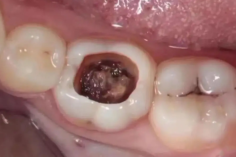 深龋露出黄褐色的牙根图 深龋露出黄褐色的牙根图