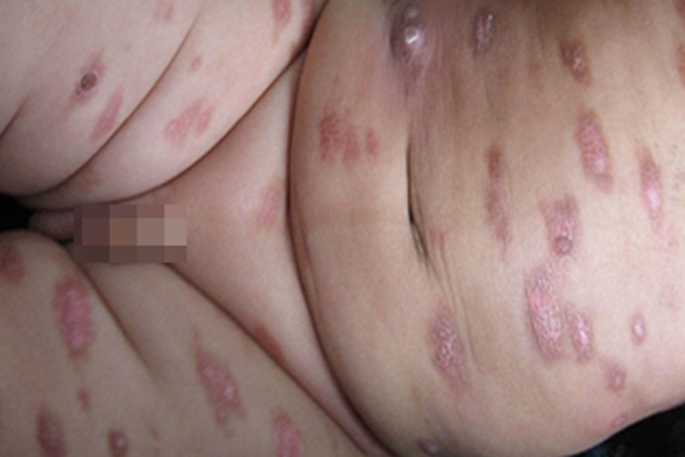 色素性荨麻疹腹部红斑图