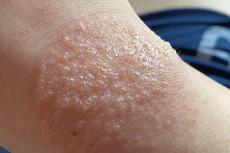 日照性皮炎水疱图