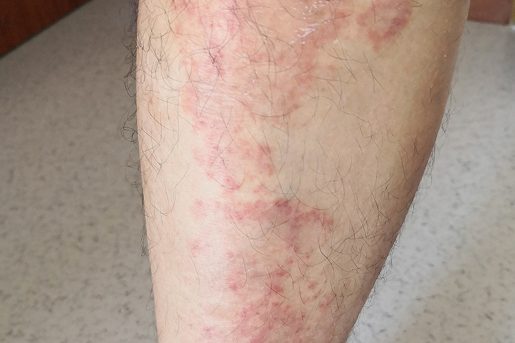 艾滋病小腿有玫瑰糠疹图