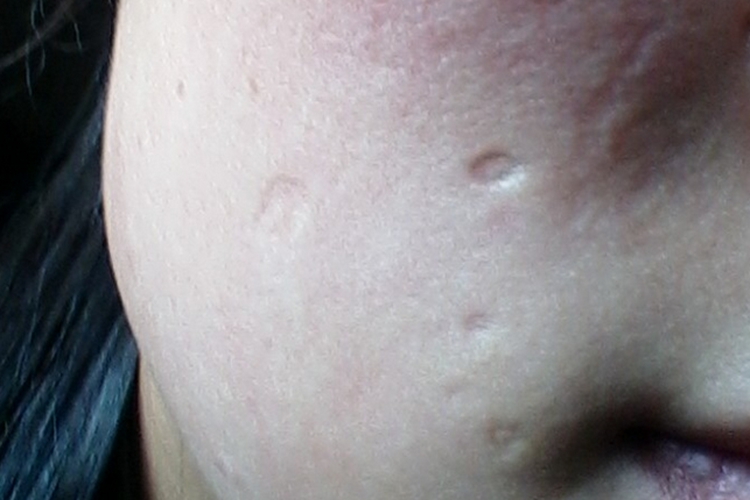 水痘消退后瘢痕图