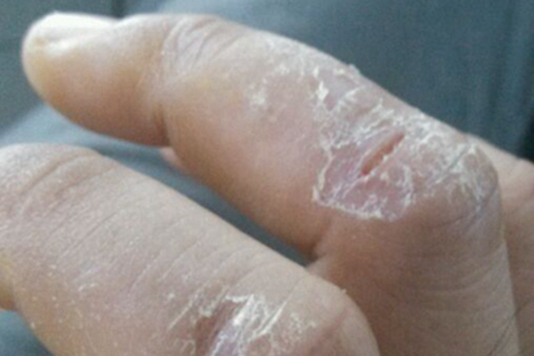 角化过度型手癣图