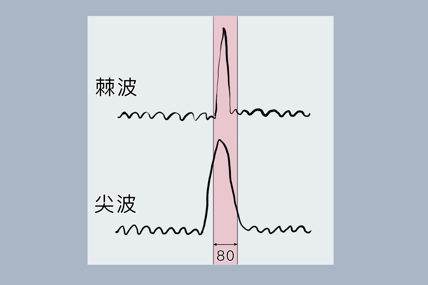 异常脑电图尖波图