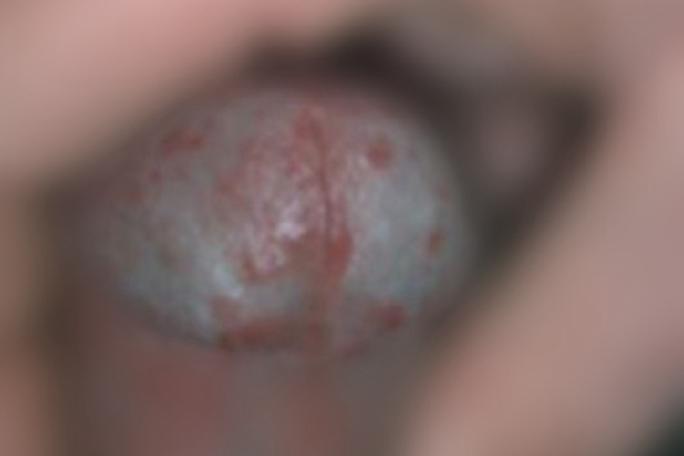 阴茎结核疹龟头小疙瘩图