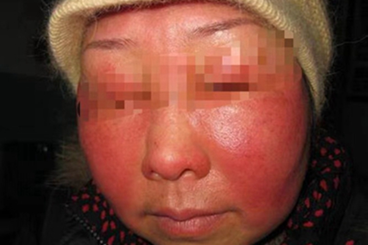 光毒性接触性皮炎面部红肿图 光毒性接触性皮炎面部红肿图