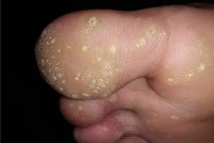 掌跖点状角化白斑图