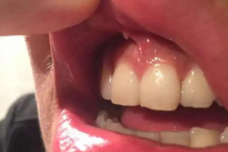 尖锐湿疣上唇系带单发疣体图