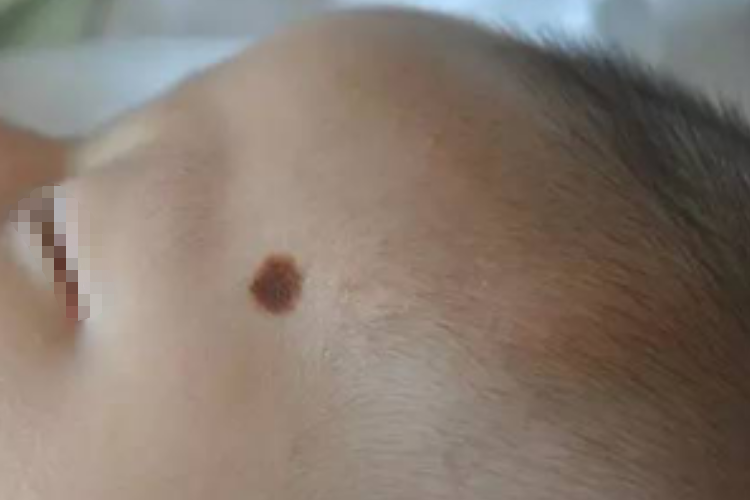 婴儿黑色素瘤早期症状图