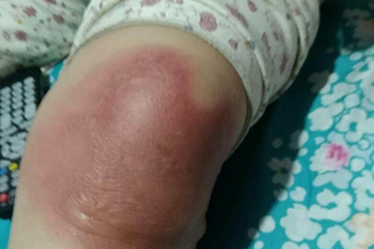 植物光皮炎膝盖红肿图