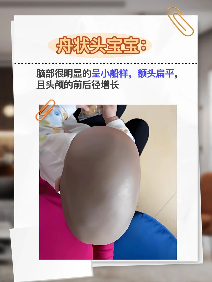 舟状头宝宝，4岁智力正常，惊喜还是担忧？