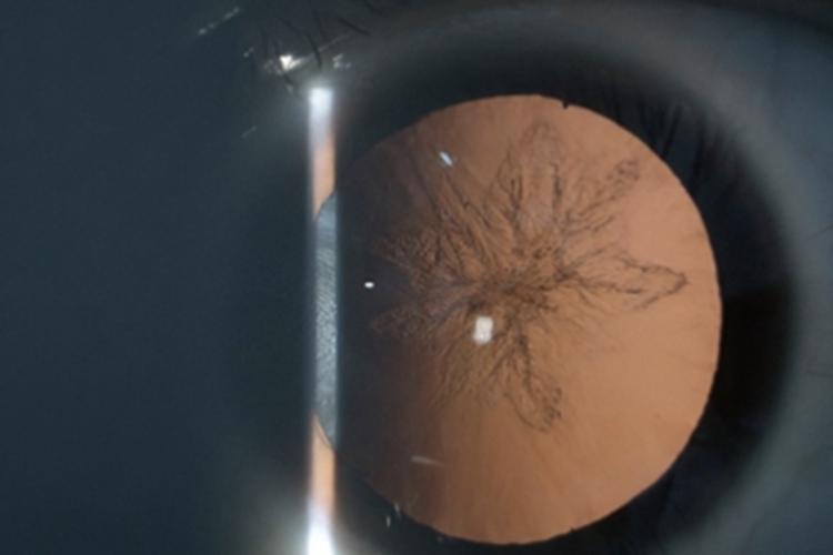 糖皮质激素所致的白内障眼球纹图 糖皮质激素所致的白内障眼球纹图