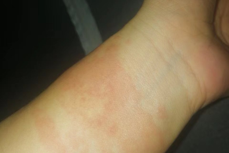 身体乳过敏红斑图